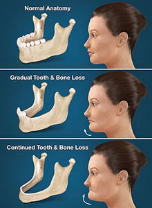 Dental Implants Clinton Township